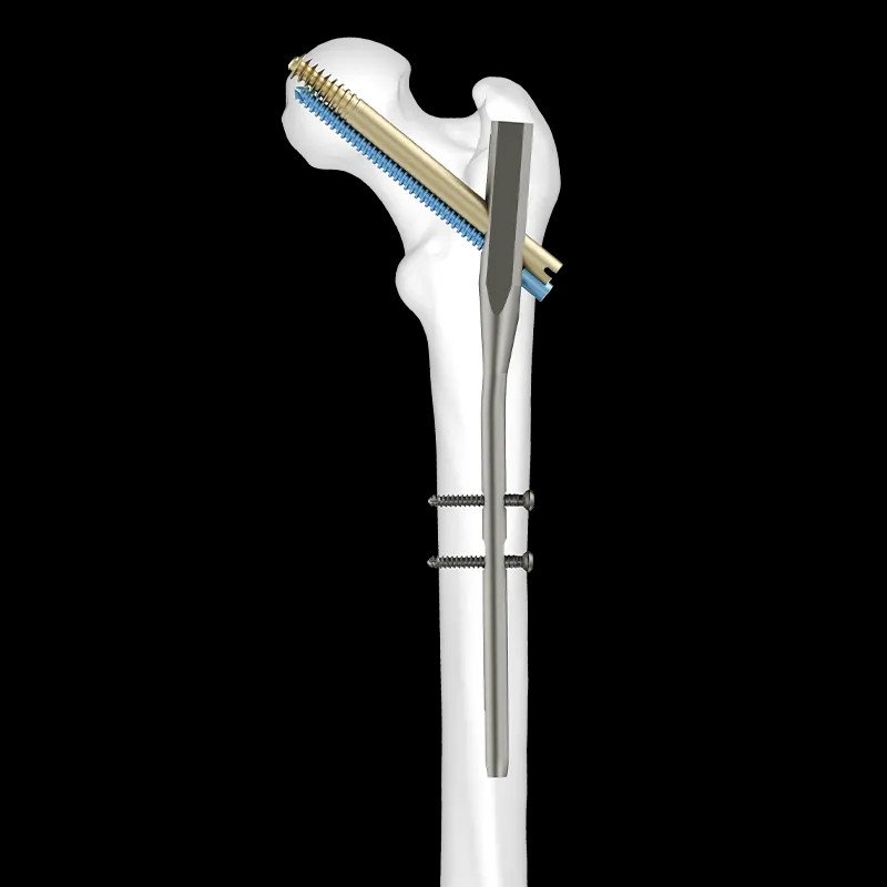 Intramedullary nail